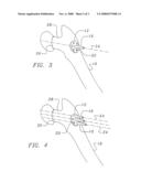 Bone end (epiphysis) fracture fixation device and method of use diagram and image