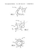 MOUNTS FOR IMPLANTABLE EXTRA-ARTICULAR SYSTEMS diagram and image