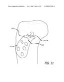 MOUNTS FOR IMPLANTABLE EXTRA-ARTICULAR SYSTEMS diagram and image