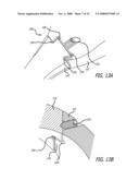 MOUNTS FOR IMPLANTABLE EXTRA-ARTICULAR SYSTEMS diagram and image