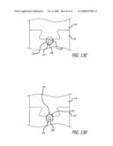 MOUNTS FOR IMPLANTABLE EXTRA-ARTICULAR SYSTEMS diagram and image