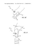 MOUNTS FOR IMPLANTABLE EXTRA-ARTICULAR SYSTEMS diagram and image