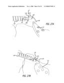 MOUNTS FOR IMPLANTABLE EXTRA-ARTICULAR SYSTEMS diagram and image