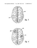 Methods and Apparatus for Effectuating a Lasting Change in a Neural Function of a Patient, Including Via Mechanical Force on Neural Tissue diagram and image