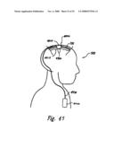 Methods and Apparatus for Effectuating a Lasting Change in a Neural Function of a Patient, Including Via Mechanical Force on Neural Tissue diagram and image