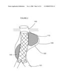 PREVENTION OF DISPLACEMENT OF PROSTHETIC DEVICES WITHIN ANEURYSMS diagram and image