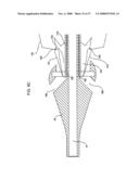 IMPLANTABLE DEVICES FOR THE TREATMENT OF INTERSECTING LUMENS diagram and image