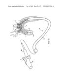 IMPLANTABLE DEVICES FOR THE TREATMENT OF INTERSECTING LUMENS diagram and image