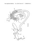 IMPLANTABLE DEVICES FOR THE TREATMENT OF INTERSECTING LUMENS diagram and image