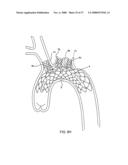 IMPLANTABLE DEVICES FOR THE TREATMENT OF INTERSECTING LUMENS diagram and image