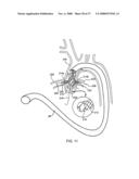 IMPLANTABLE DEVICES FOR THE TREATMENT OF INTERSECTING LUMENS diagram and image