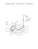 IMPLANTABLE DEVICES FOR THE TREATMENT OF INTERSECTING LUMENS diagram and image