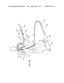 IMPLANTABLE DEVICES FOR THE TREATMENT OF INTERSECTING LUMENS diagram and image