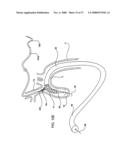 IMPLANTABLE DEVICES FOR THE TREATMENT OF INTERSECTING LUMENS diagram and image