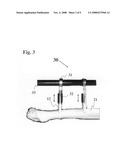 Femoral hip stem explant system diagram and image