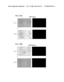 Treatment Of Injury To The Brain By Inhibition Of Acid Sensing ION Channels diagram and image