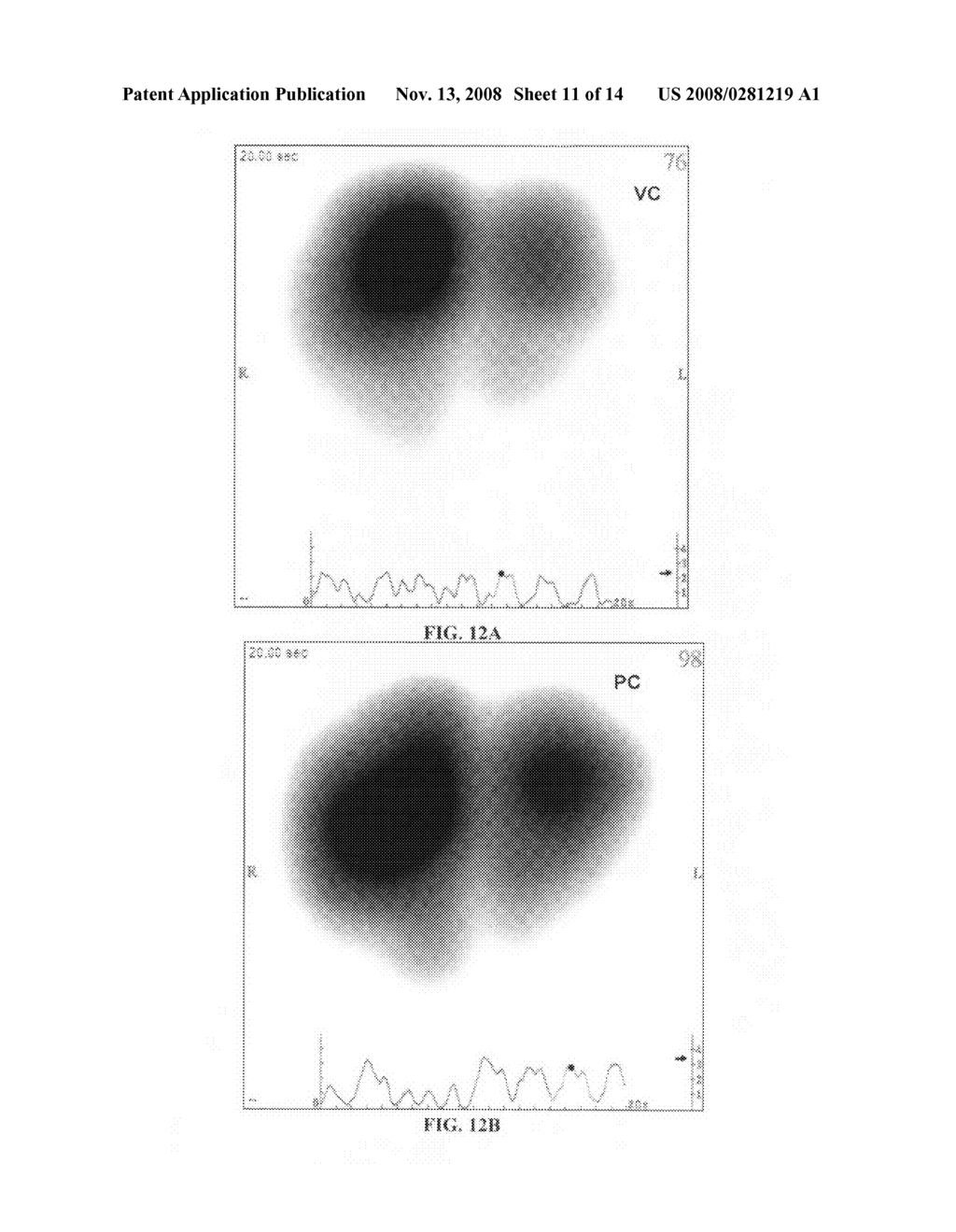 Method and System for Assessing Lung Condition and Managing Mechanical Respiratory Ventilation - diagram, schematic, and image 12