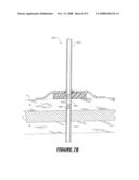 EXTERNAL FIXATION ASSEMBLY AND METHOD OF USE diagram and image