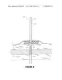 EXTERNAL FIXATION ASSEMBLY AND METHOD OF USE diagram and image