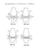 Patient Selectable Joint Arthroplasty Devices and Surgical Tools diagram and image