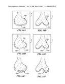 Patient Selectable Joint Arthroplasty Devices and Surgical Tools diagram and image