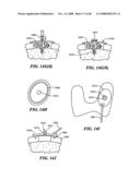 Patient Selectable Joint Arthroplasty Devices and Surgical Tools diagram and image