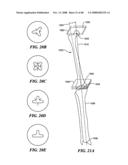 Patient Selectable Joint Arthroplasty Devices and Surgical Tools diagram and image