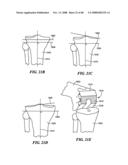 Patient Selectable Joint Arthroplasty Devices and Surgical Tools diagram and image