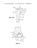 Patient Selectable Joint Arthroplasty Devices and Surgical Tools diagram and image