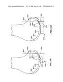 Patient Selectable Joint Arthroplasty Devices and Surgical Tools diagram and image