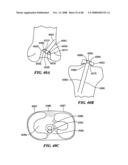 Patient Selectable Joint Arthroplasty Devices and Surgical Tools diagram and image