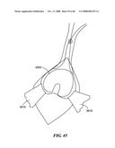 Patient Selectable Joint Arthroplasty Devices and Surgical Tools diagram and image