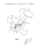 Patient Selectable Joint Arthroplasty Devices and Surgical Tools diagram and image