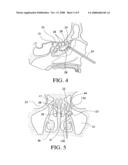 Balloon catheters and methods for treating paranasal sinuses diagram and image