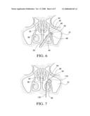 Balloon catheters and methods for treating paranasal sinuses diagram and image