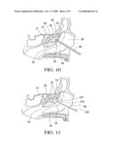 Balloon catheters and methods for treating paranasal sinuses diagram and image