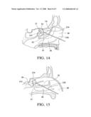 Balloon catheters and methods for treating paranasal sinuses diagram and image