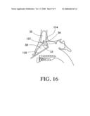 Balloon catheters and methods for treating paranasal sinuses diagram and image