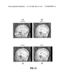 System and Method for Consistent Detection of Mid-Sagittal Planes for Magnetic Resonance Brain Scans diagram and image