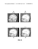 System and Method for Consistent Detection of Mid-Sagittal Planes for Magnetic Resonance Brain Scans diagram and image