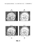 System and Method for Consistent Detection of Mid-Sagittal Planes for Magnetic Resonance Brain Scans diagram and image