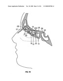 Ethmoidotomy System and Implantable Spacer Devices Having Therapeutic Substance Delivery Capability for Treatment of Paranasal Sinusitis diagram and image