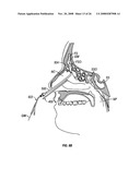 Ethmoidotomy System and Implantable Spacer Devices Having Therapeutic Substance Delivery Capability for Treatment of Paranasal Sinusitis diagram and image