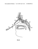 Ethmoidotomy System and Implantable Spacer Devices Having Therapeutic Substance Delivery Capability for Treatment of Paranasal Sinusitis diagram and image