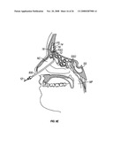 Ethmoidotomy System and Implantable Spacer Devices Having Therapeutic Substance Delivery Capability for Treatment of Paranasal Sinusitis diagram and image