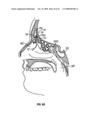 Ethmoidotomy System and Implantable Spacer Devices Having Therapeutic Substance Delivery Capability for Treatment of Paranasal Sinusitis diagram and image