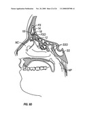 Ethmoidotomy System and Implantable Spacer Devices Having Therapeutic Substance Delivery Capability for Treatment of Paranasal Sinusitis diagram and image