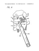 Distractor for use in spinal surgery and method of use thereof diagram and image