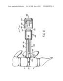 Distractor for use in spinal surgery and method of use thereof diagram and image