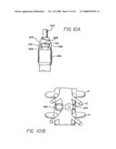 Distractor for use in spinal surgery and method of use thereof diagram and image